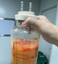 江门水动力吸脂手术要做多久？